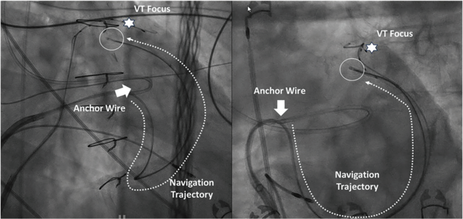 VINTAGE: A Future Guidewire-Based Ablation Technique for Deep Targets?